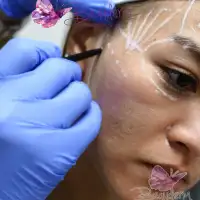 Filler Area Belakang Pipi  di Depan Telinga Yang Cekung