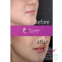 Suntik Filler Bibir Before After, Melembabkan Mengurangi Kerutan