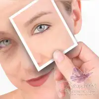 Penyebab Terjadinya Kantung Mata (Eye Bag)