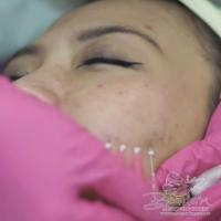 Threadlift