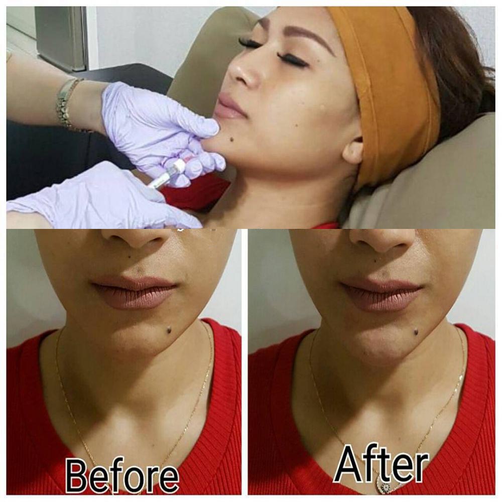 filler artis jakarta utara