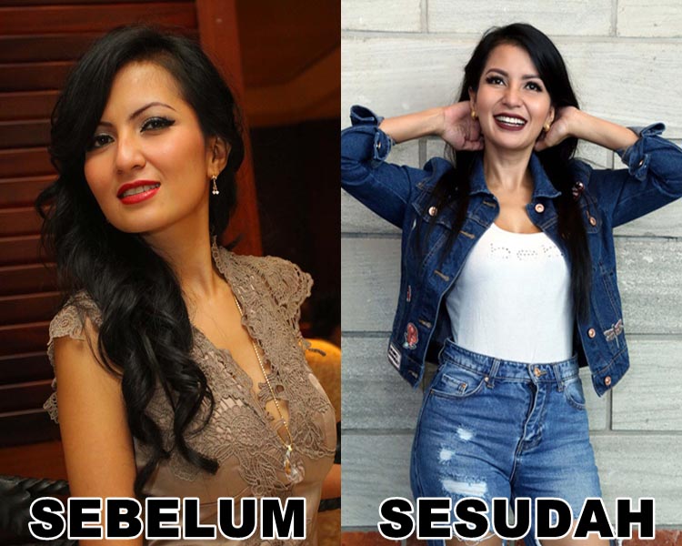 artis penampilan denagn filler suntik