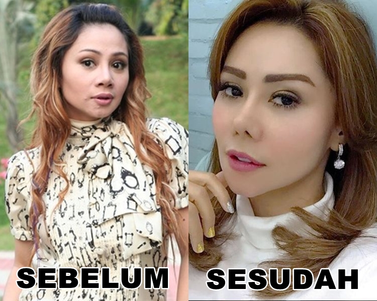 filler hidung artis